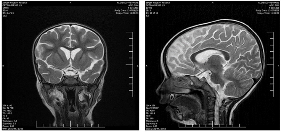 Figure 2. The MRI analysis of the brain